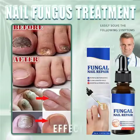 TRATAMIENTO ANTIHONGOS UÑAS EFECTIVO RÁPIDO